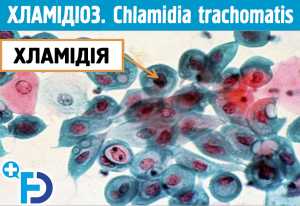 ХЛАМІДІОЗ. Chlamidia trachomatis