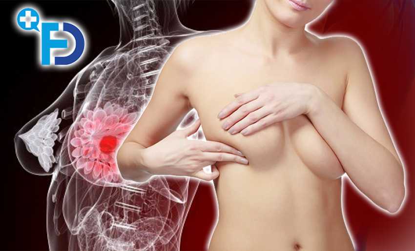 Доброякісна пухлина молочної залози (грудей): симптоми, види, лікування, причини