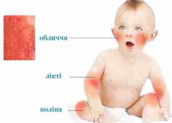 Атопічний дерматит у дітей до року: причини, симптоми, лікування