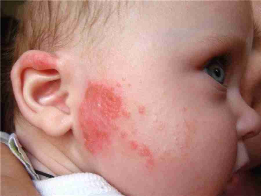 Алергія на обличчі у дитини, що робити?